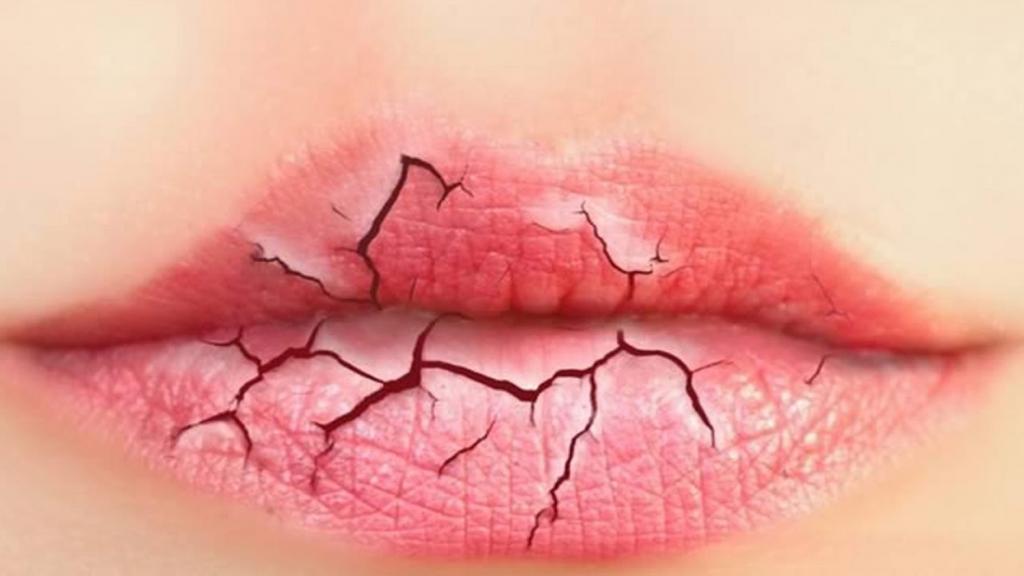 Обветренные губы: что делать, как бороться, советы косметологов и дерматологов