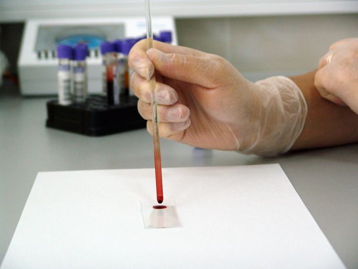 Дешевый анализ крови на туберкулез разработают для бедных государств