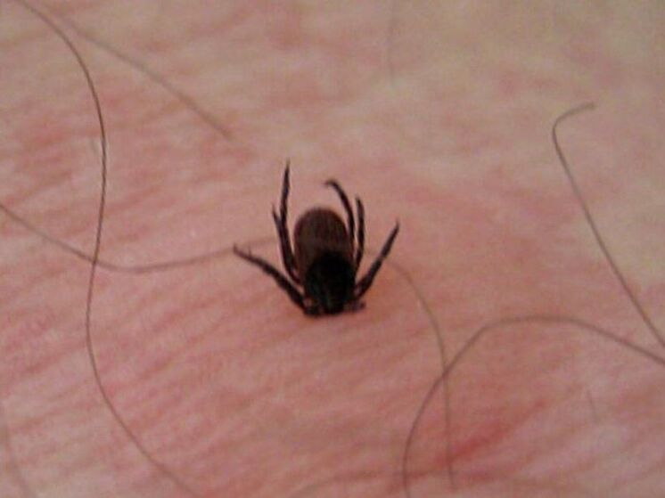 Температура, озноб и сыпь могут указывать на клещевую лихорадку, говорят карельские врачи