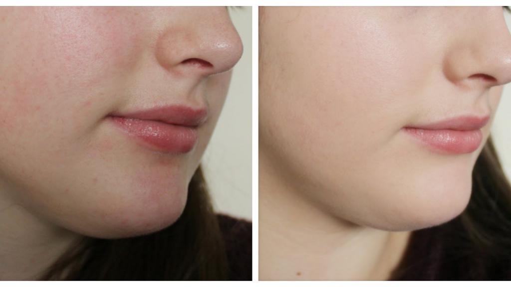 Как добиться чистой кожи лица: советы косметологов