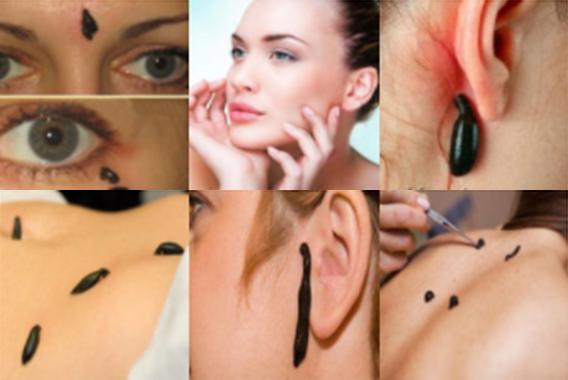 Гирудотерапия в косметологии: точки постановки