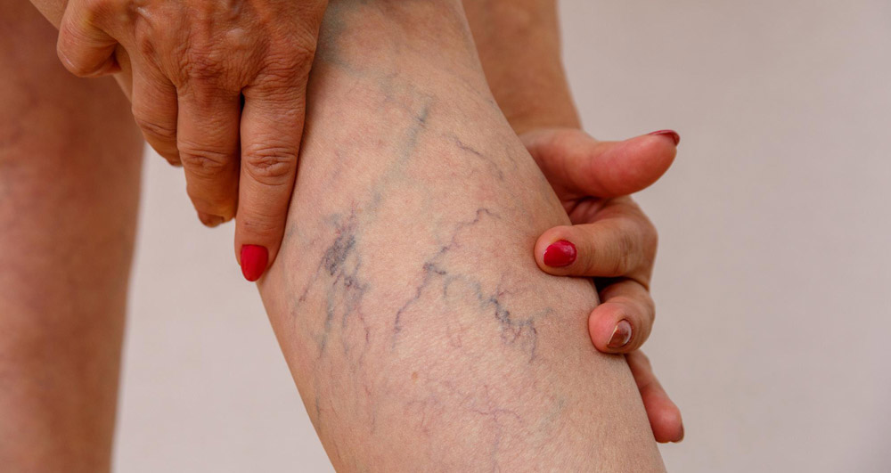 Делай эти упражнения при варикозе