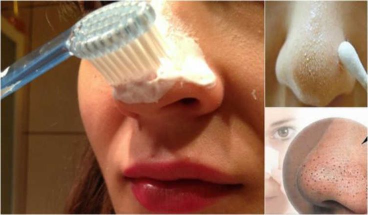 Больше никаких мучительных походов к косметологу! Хитрый трюк для избавления от черных точек.