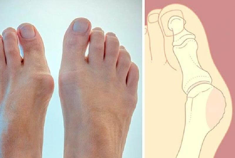 Тушари Джалаят: «Каждую ночь к выпирающей шишке прикладывай…». Бегаю как в молодости.