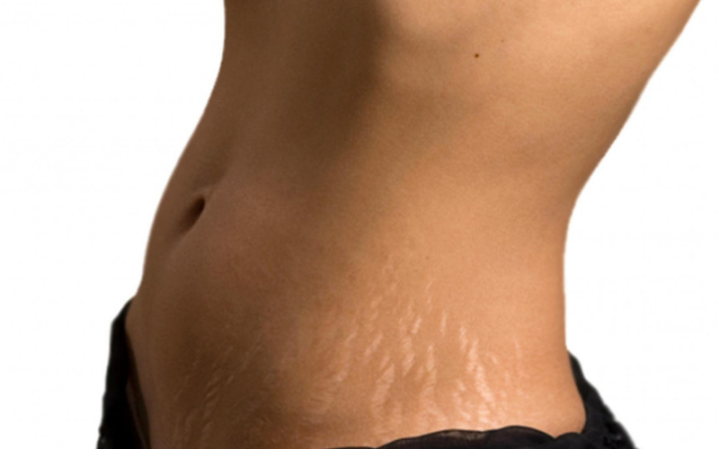 Это народное средство избавит тебя от шрамов и растяжек всего за 2 месяца!