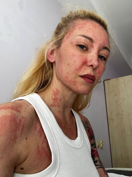 &laquo;Опухшее лицо и страшные волдыри&raquo;: дочь Мстислава Запашного экстренно попала в реанимацию