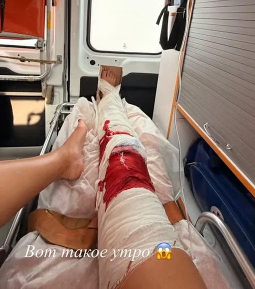 Госпитализированная Ольга Бузова перенесла операцию на ноге: что случилось&nbsp;